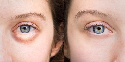 Puffy Eyes and How To Treat Them